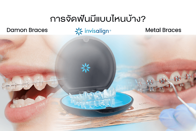 การจัดฟัน