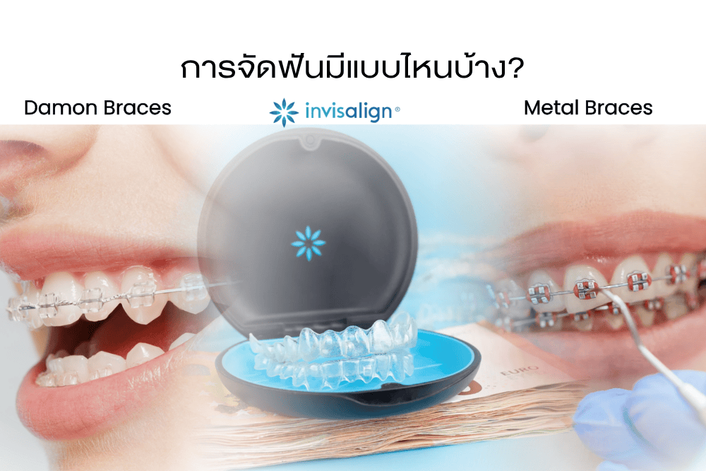 Read more about the article การจัดฟันมีแบบไหนบ้าง?