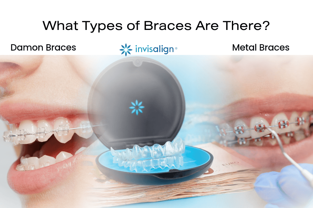 Braces