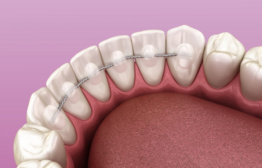 การใส่รีเทนเนอร์แบบติดแน่น (Fixed Retainer)