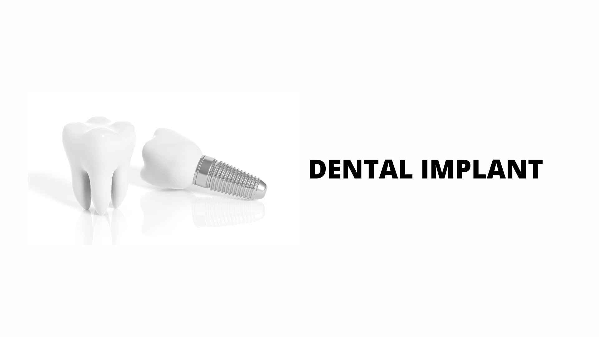 Read more about the article Implant is fit for you?