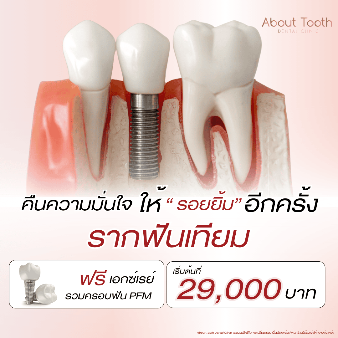 รากฟันเทียม