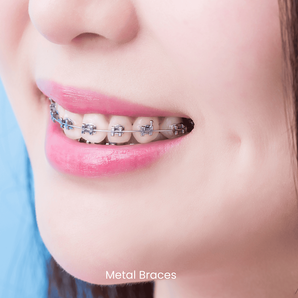Braces
