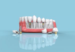 การใส่รากฟันเทียม - about tooth dental