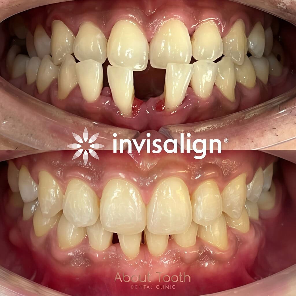 Invisalign