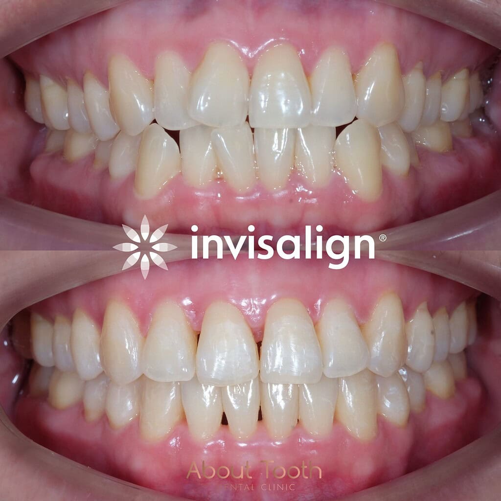 Invisalign