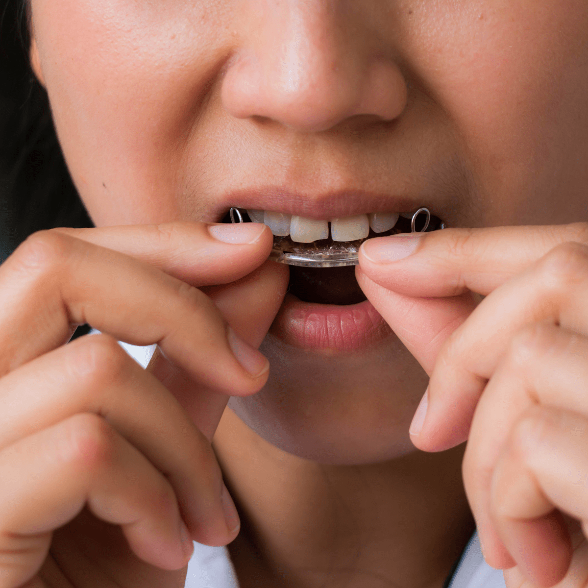 What happens to you if you do not wear a retainer regularly after braces ?