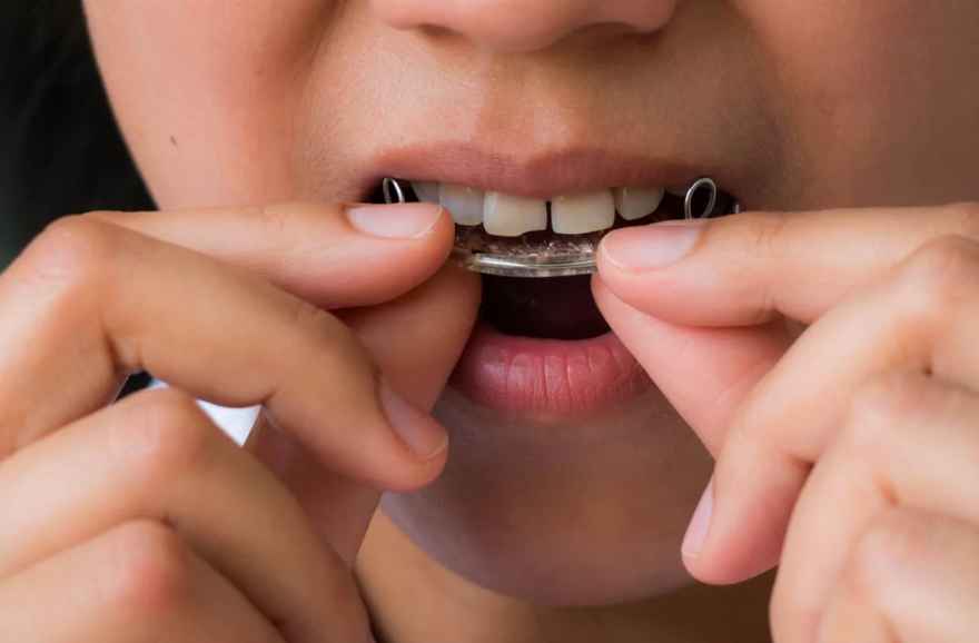 The Importance of Wearing a Retainer After Braces