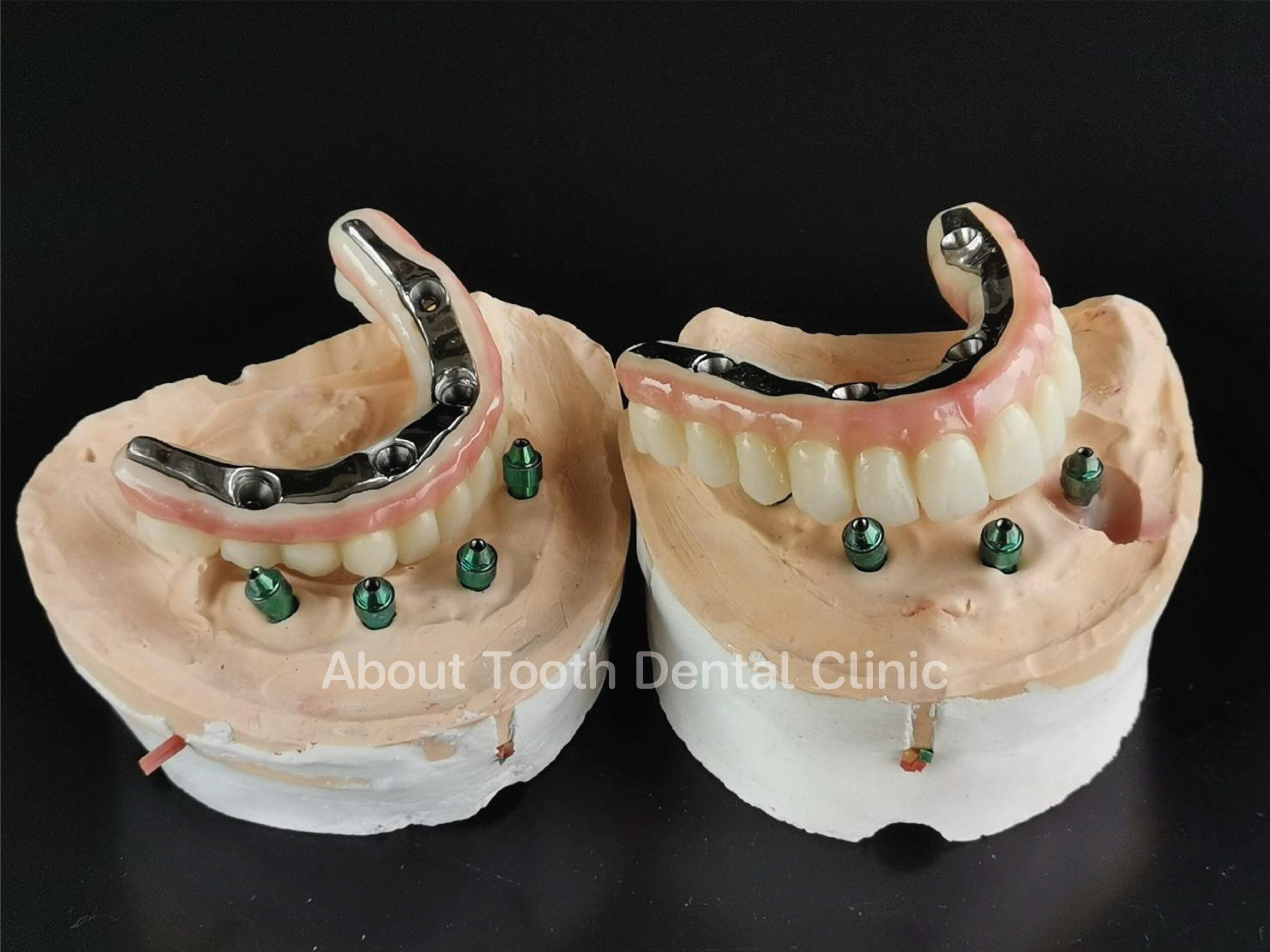 All-on-4 : Dental Implants