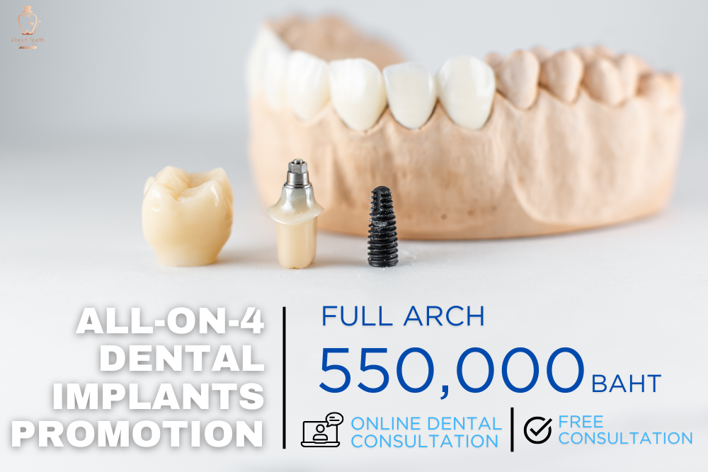 all on 4 dental implant promotion