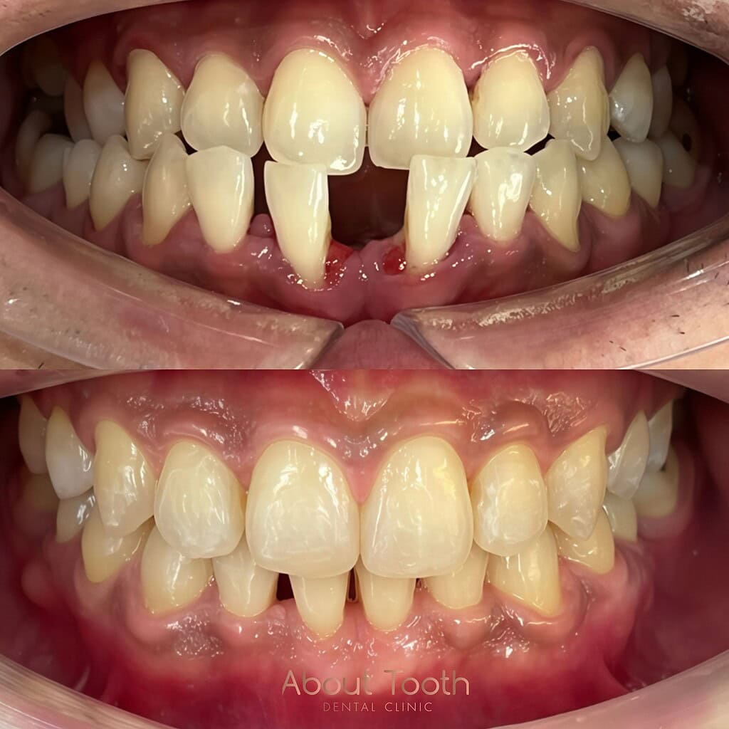pro-invisalign