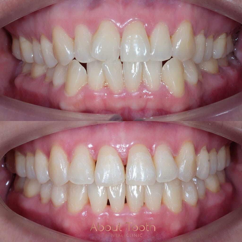 pro-invisalign