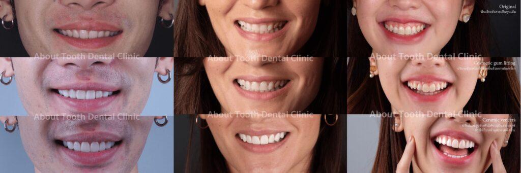 Veneers Case Reviews