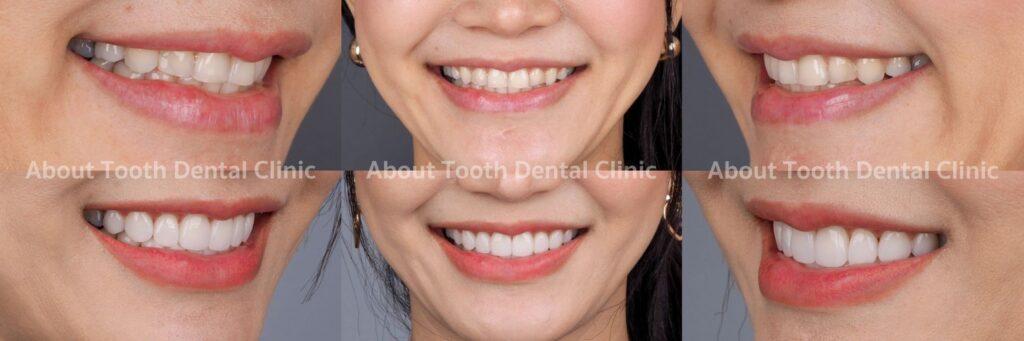 Veneers case reviews 10