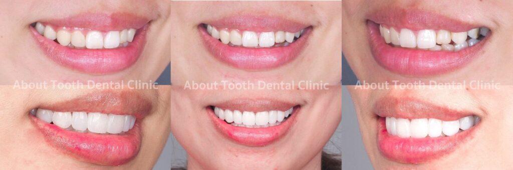 Veneers case reviews 12