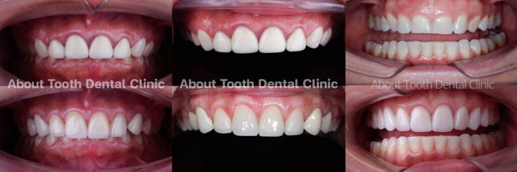 Veneers case reviews 22