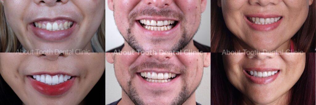 Veneers case reviews 15