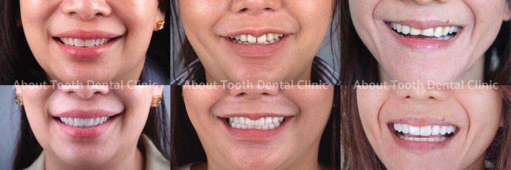 Veneers case reviews 16