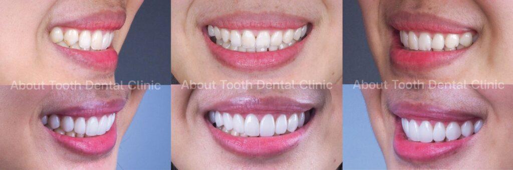 Veneers case reviews 14