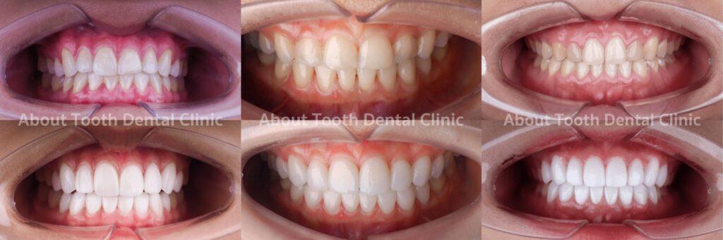 Veneers case reviews 19