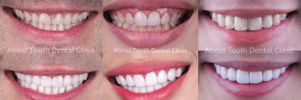 Veneers case reviews 18