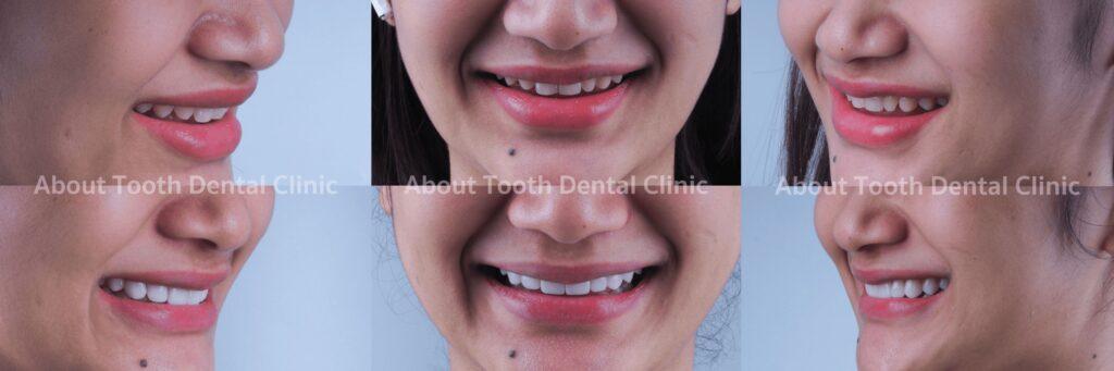 Veneers case reviews 3