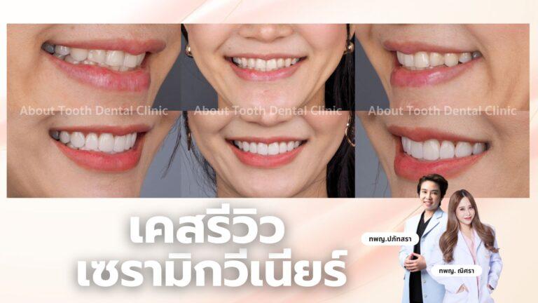 เคสรีวิวเซรามิกวีเนียร์คนไข้