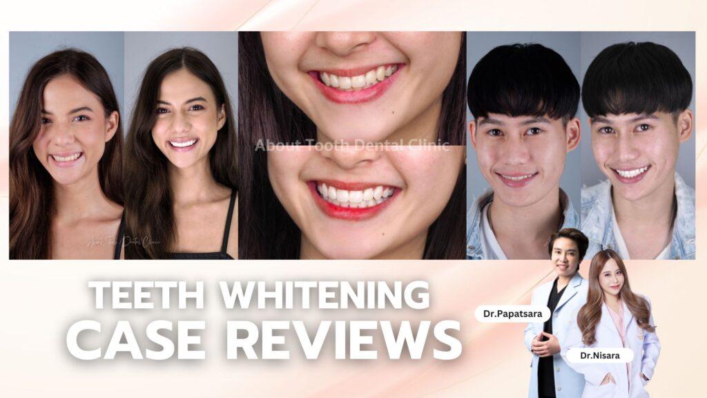 Teeth Whitening Case Reviews - [:th]About Tooth Dental Clinic[:]