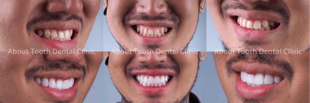 Veneers case reviews 4