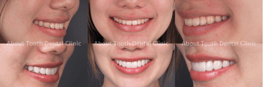 Veneers case reviews 5