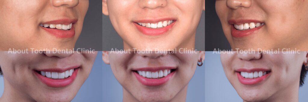 Veneers case reviews 6