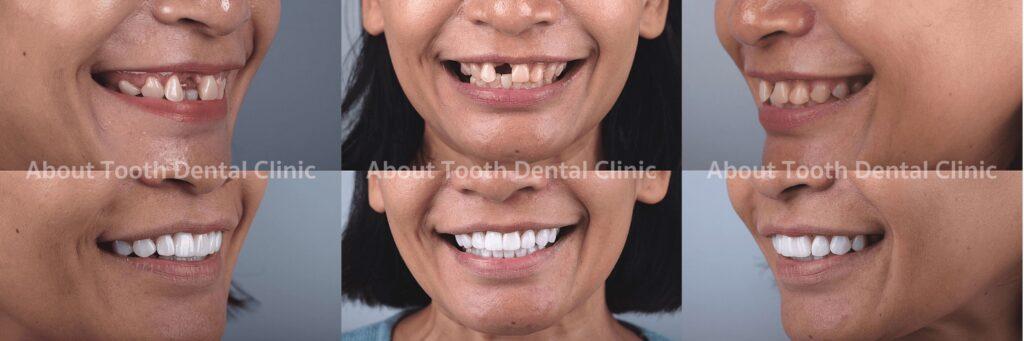 Veneers case reviews 7