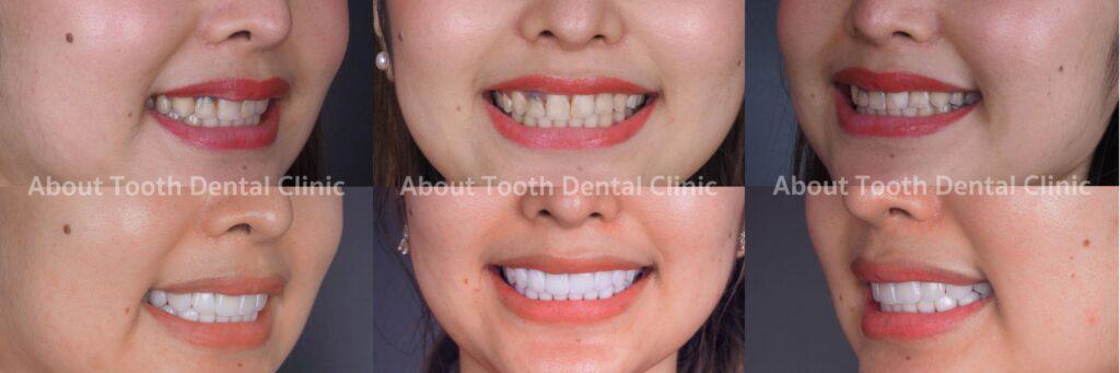 Veneers case reviews 8