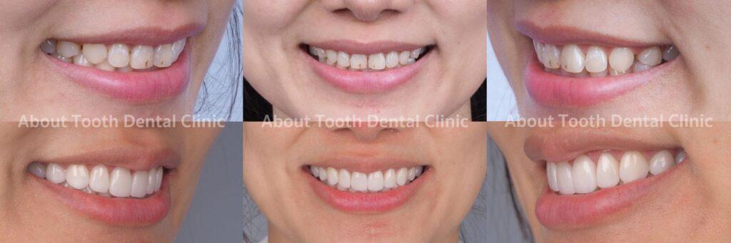 Veneers case reviews 9