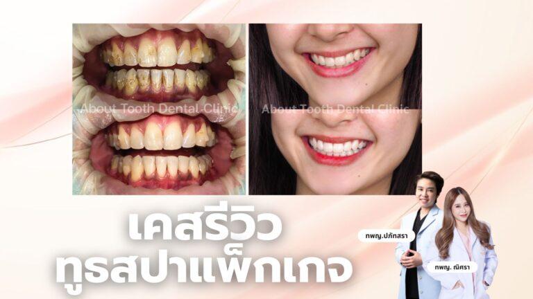 เคสรีวิวแพ็กเกจ Tooth Spa