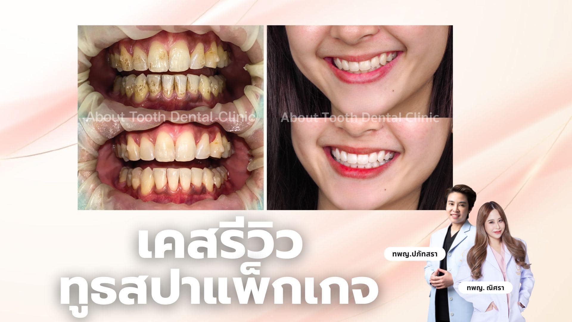 รีวิวเคสแพ็กเกจ Tooth Spa จากคนไข้จริง