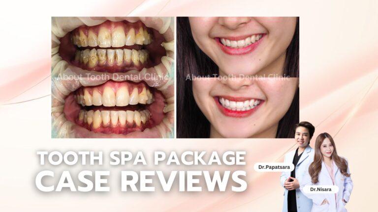 Tooth Spa Package Case Reviews