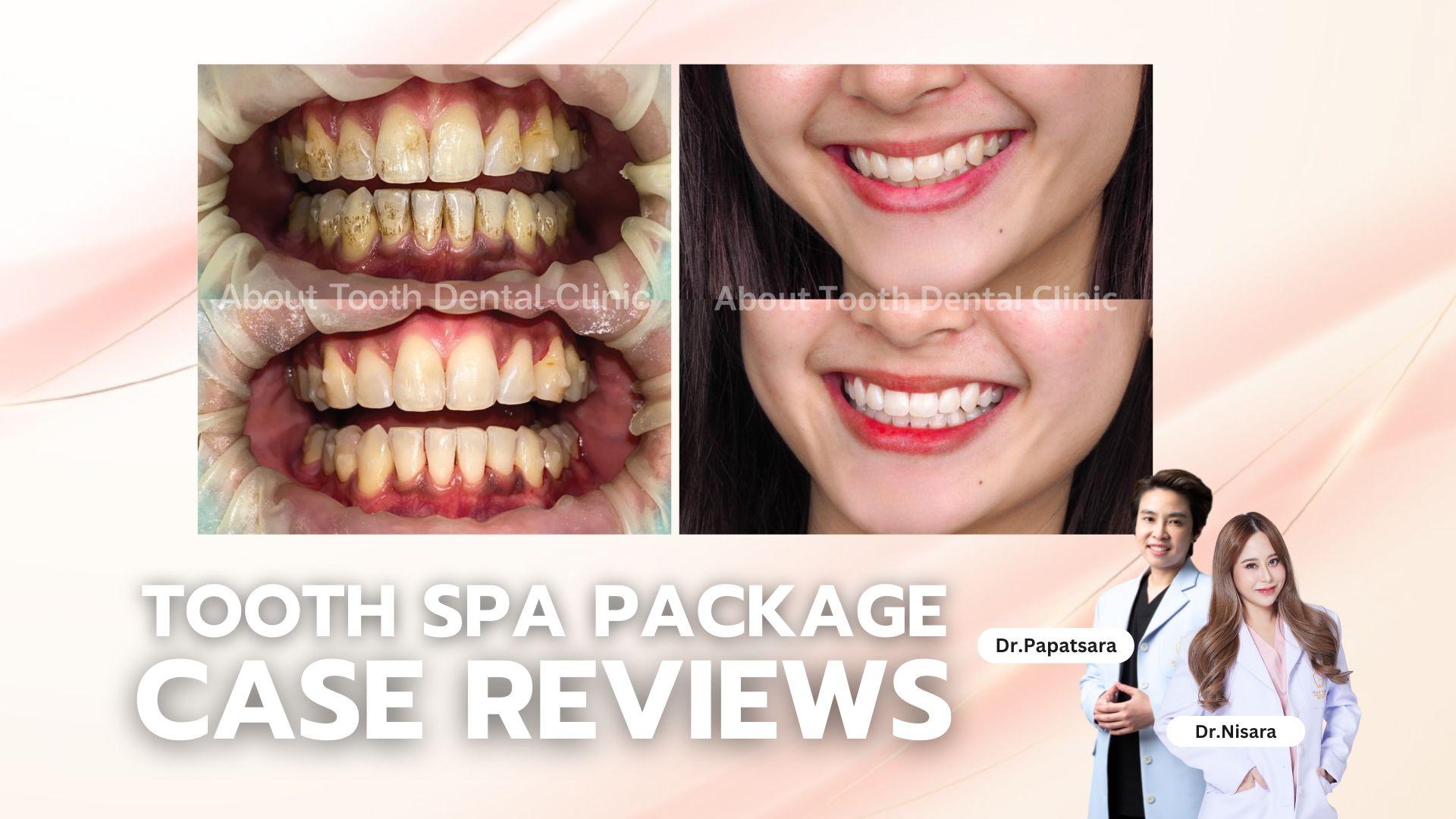 Tooth Spa Package Case Reviews