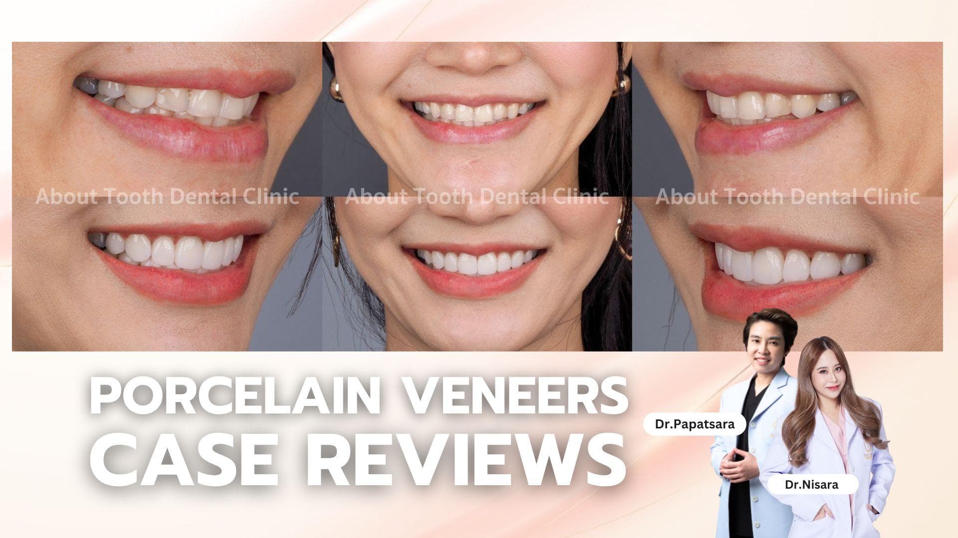 Porcelain Veneers Case Reviews