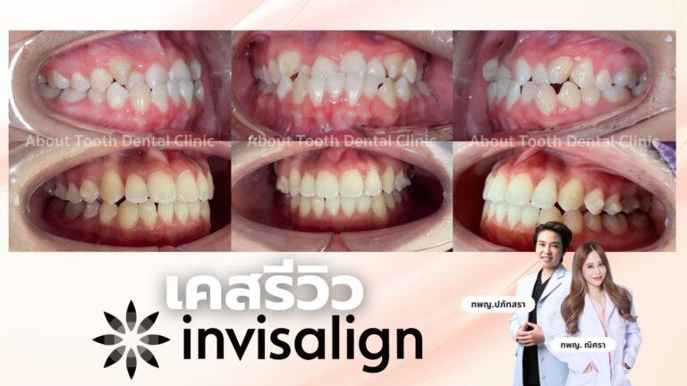 เคสรีวิว Invisalign