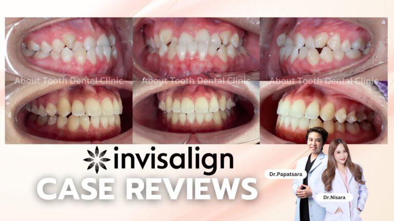 Invisalign Case Reviews