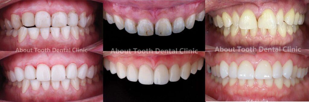 Veneers case reviews 21