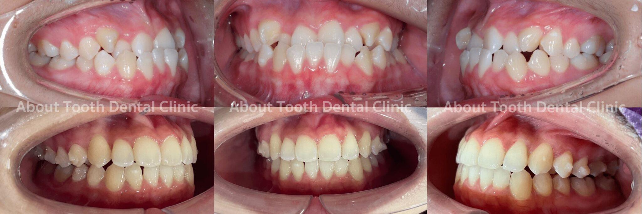 Invisalign Case Reviews - [:th]About Tooth Dental Clinic[:]