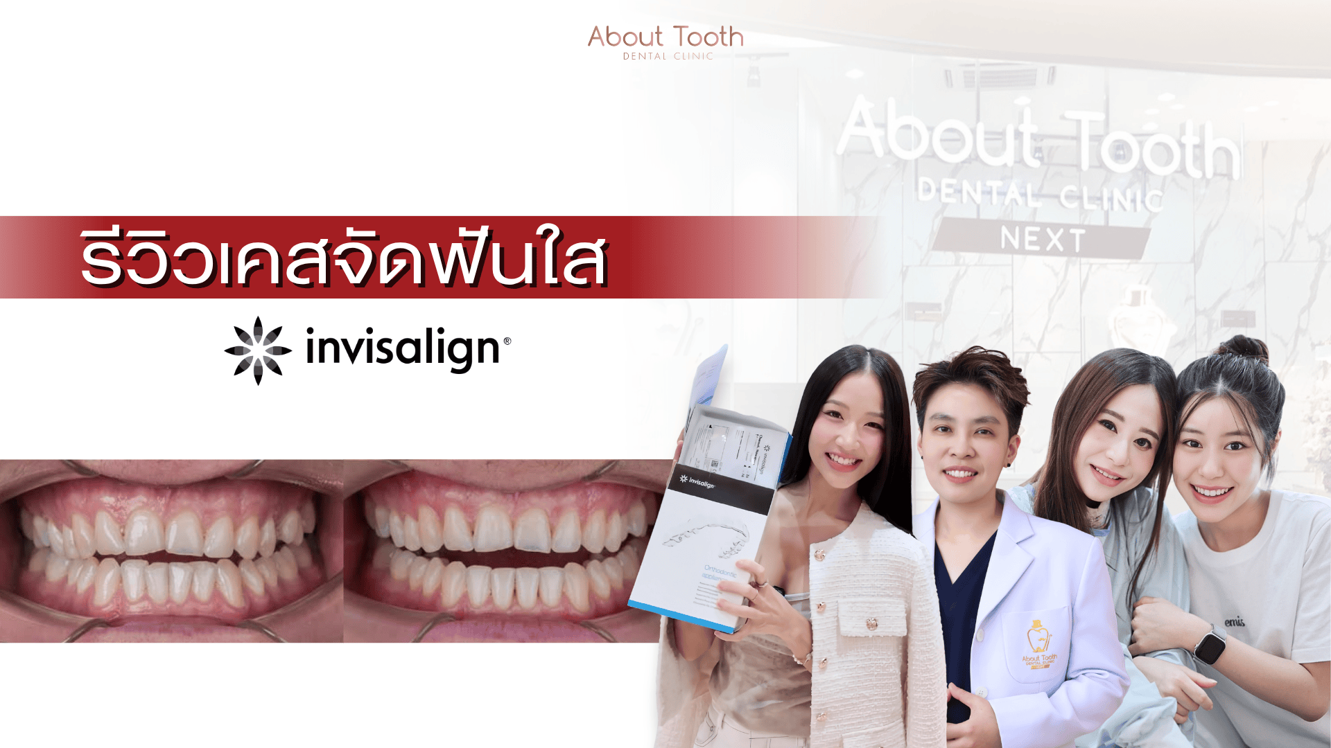 จัดฟันใส invisalign
