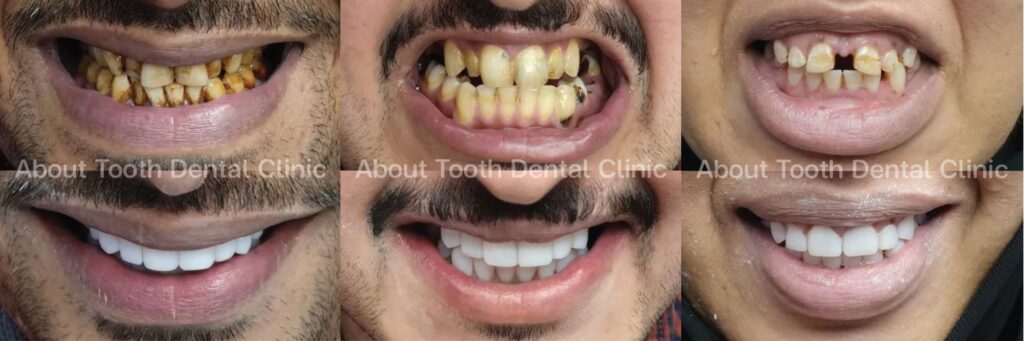 composite veneers case review 2