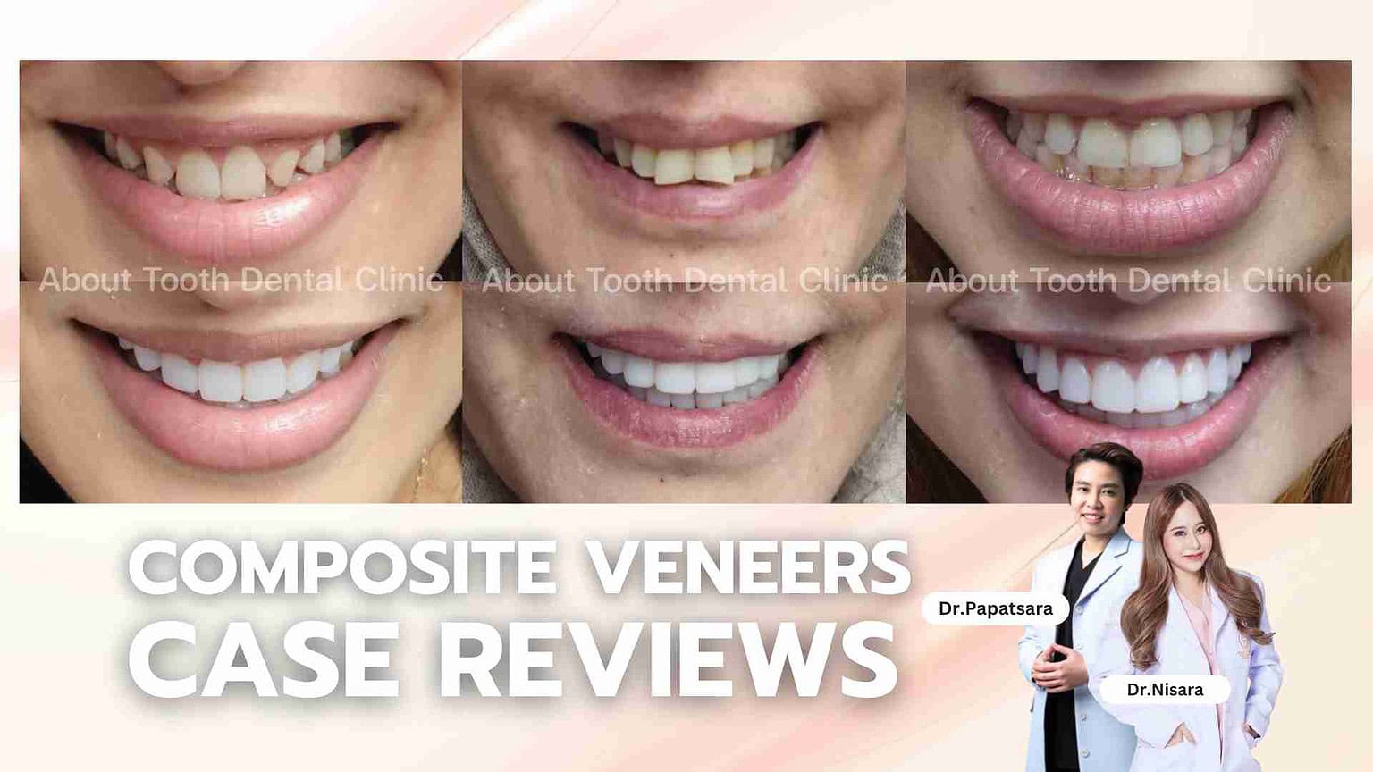 Composite Veneers Case Reviews - [:th]About Tooth Dental Clinic[:]