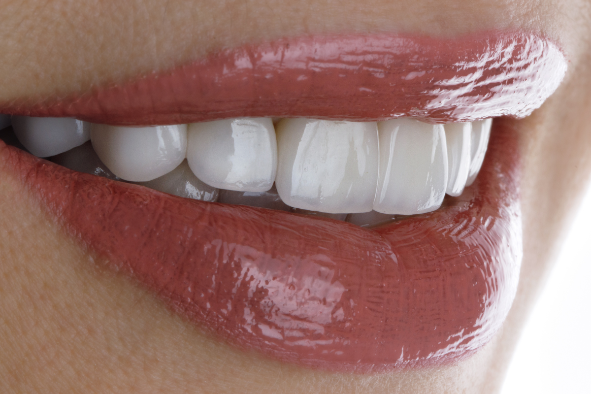 Advantages of Dental Veneers: