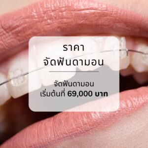 ราคาจัดฟันดามอน