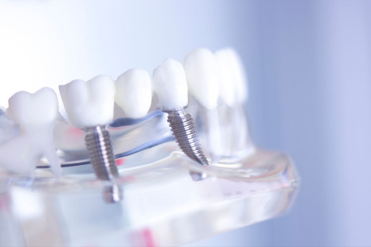 Dental implants