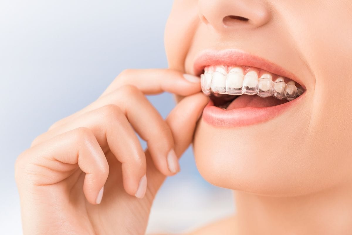 invisalign service